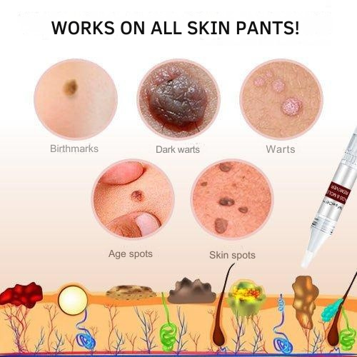 Stift zur örtlichen Behandlung von Warzen und Hautanhängseln mit Präzisionsapplikator – 3 ml