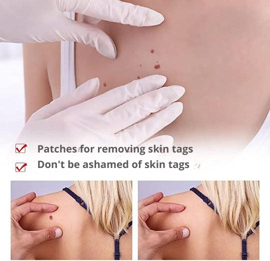 Stift zur örtlichen Behandlung von Warzen und Hautanhängseln mit Präzisionsapplikator – 3 ml